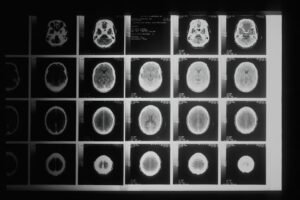 Set of brain MRI scan images